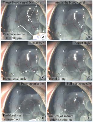 An automatic drug injection device with spatial micro-force perception guided by an microscopic image for robot-assisted ophthalmic surgery